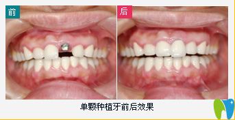 單顆牙缺失即刻種植效果