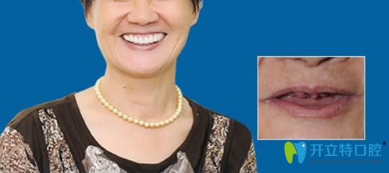 重慶華美口腔好不好？華美牙科全口牙齒缺失種植真人案例揭曉：