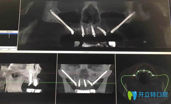 王明分析穿顴種植的利弊