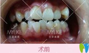 在北京美萊口腔做隱形牙齒矯正500天牙套畢業(yè)打卡,臉型變了