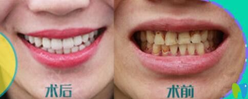 重慶華美牙科靠譜嗎？苗智許超薄瓷貼面修復(fù)牙齒案例對(duì)比效果公布