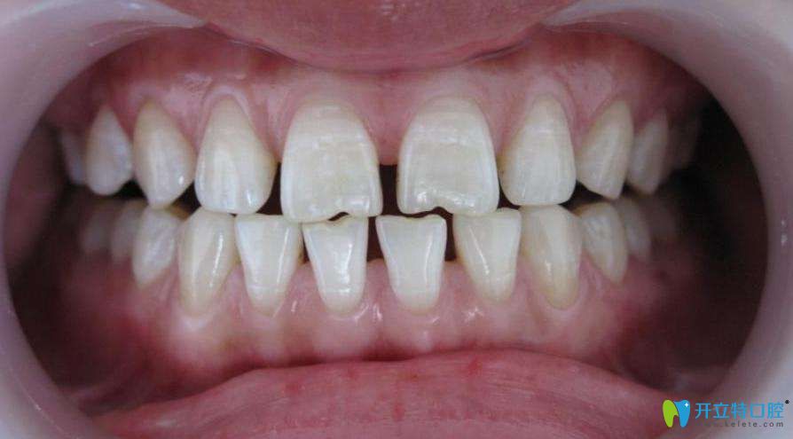 牙周炎醫(yī)生不建議整牙是真的嗎?談牙周炎能不能做牙齒矯正