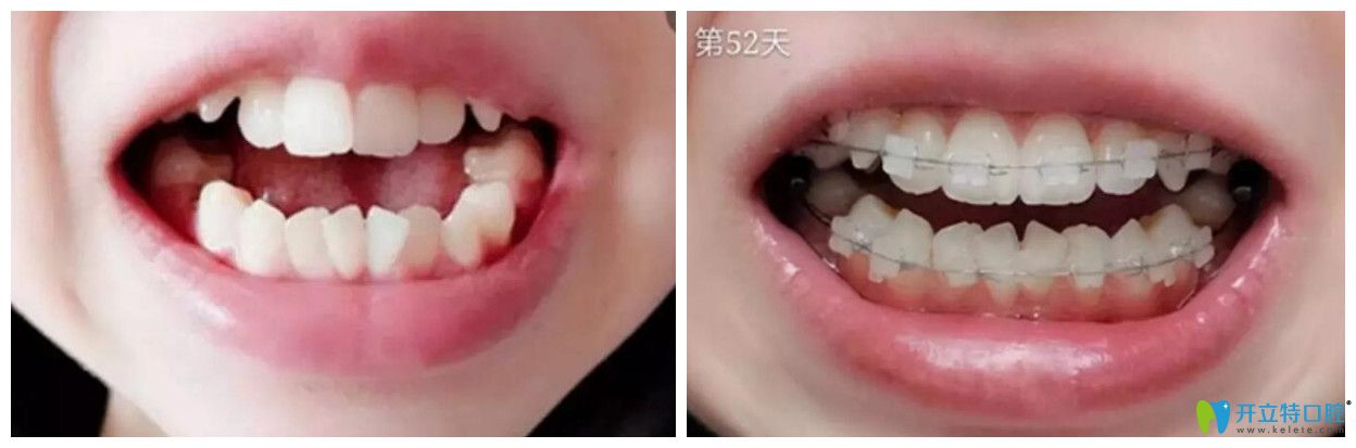 漢中小白象口腔戴半隱形牙套矯正52天 漢中小白象口腔戴半隱形牙套矯正52天