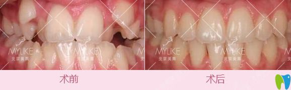 北京美萊口腔虎牙隱形矯正前后對(duì)比圖