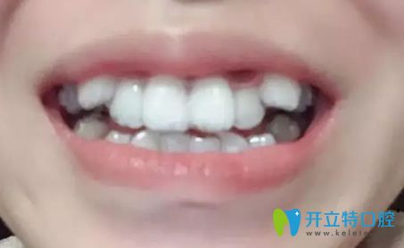 我在北京美萊做隱形牙齒矯正第3個月 我在北京美萊做隱形牙齒矯正第3個月