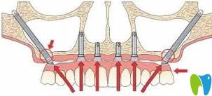什么是穿顴種植技術(shù)示意圖