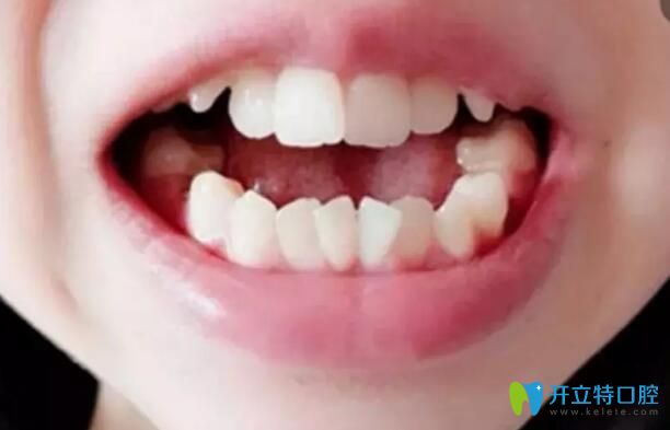 在漢中小白象做陶瓷半隱形矯正已117天了,附正畸價(jià)格及結(jié)果