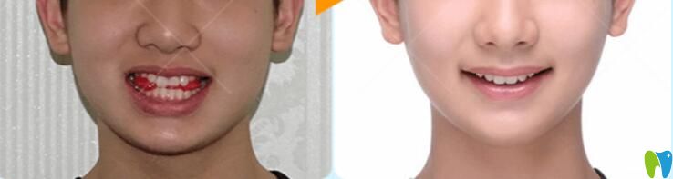 重慶哪家牙科正畸好？華美牙科矯正案例效果來(lái)驗(yàn)證