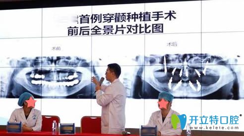 穿顴種植手術(shù)前后全景片對比圖