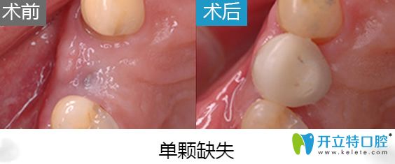 北京美萊整形口腔科種植牙案例