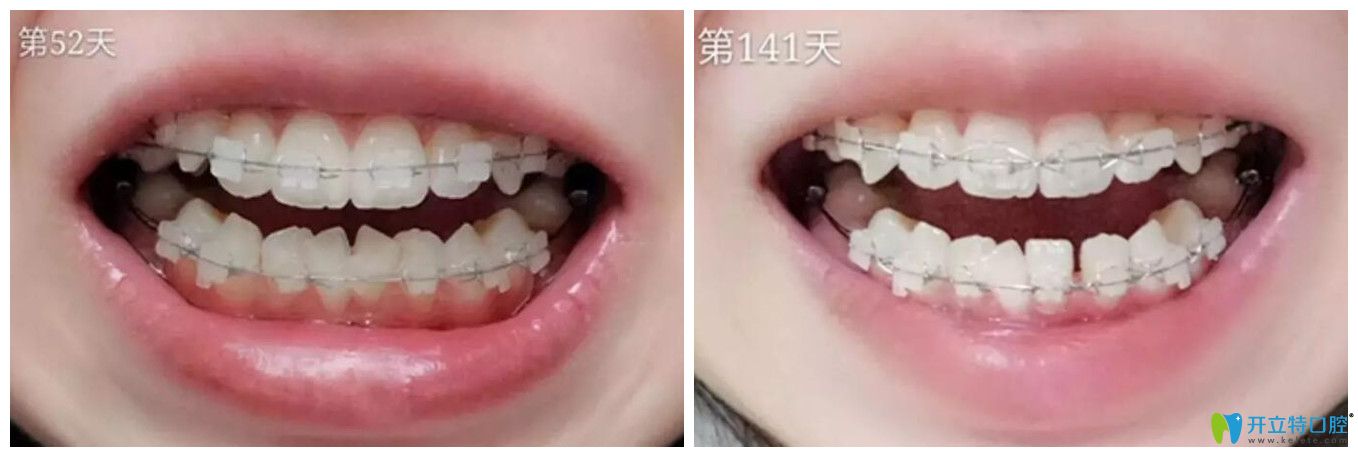 小白象口腔半隱形矯正52天和141天對比圖 小白象口腔半隱形矯正52天和141天對比圖