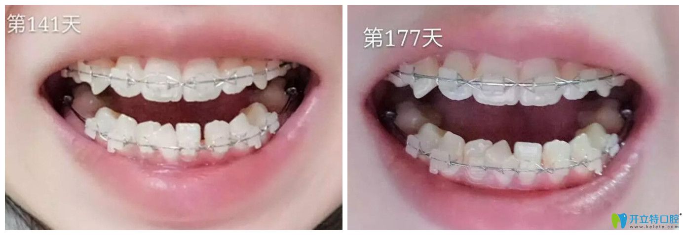屬于漢中小白象口腔牙齒矯正141天和177天對比<span style= 屬于漢中小白象口腔牙齒矯正141天和177天對比<span style=