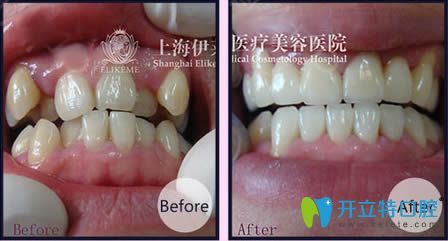<!--<i data=20240703-sp></i>-->伊萊美王海鑫醫(yī)生虎牙矯正前后對(duì)比照 <!--<i data=20240703-sp></i>-->伊萊美王海鑫醫(yī)生虎牙矯正前后對(duì)比照
