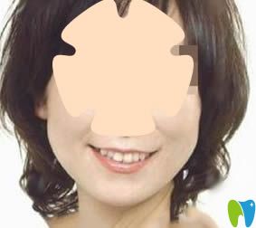 我在太原眾牙口腔做的人工種植牙術后照