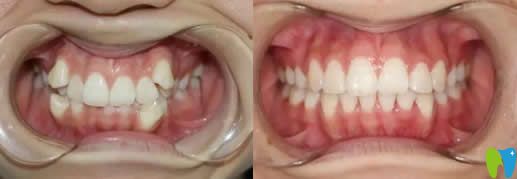 北京京通口腔科尚書虎牙隱形矯正案例 北京京通口腔科尚書虎牙隱形矯正案例