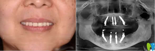 在<!--<i data=20240703-sp></i>-->宏康口腔做完全口種植牙的效果及全景圖 在<!--<i data=20240703-sp></i>-->宏康口腔做完全口種植牙的效果及全景圖