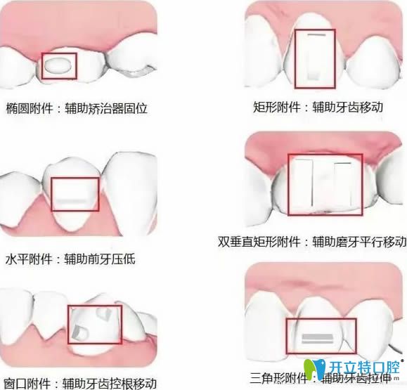 隱形牙套附件不同種類的相對作用示意圖