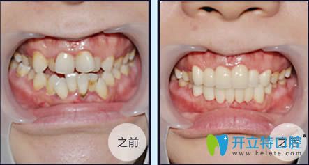 <!--<i data=20240703-sp></i>-->伊萊美牙科李慶云牙齒擁擠矯正前后對(duì)比效果 <!--<i data=20240703-sp></i>-->伊萊美牙科李慶云牙齒擁擠矯正前后對(duì)比效果