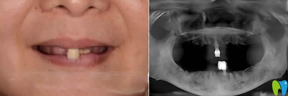 通過我的全口種植牙案例來評(píng)估上海宏康口腔做種牙怎么樣