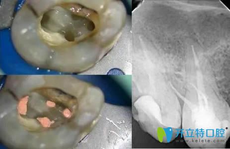 活髓切斷術(shù)和根管治療的區(qū)別對(duì)比圖