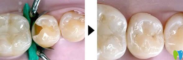 網(wǎng)上說千萬不要去補(bǔ)牙是真的嗎