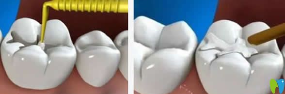 補(bǔ)牙會(huì)越補(bǔ)越爛嗎