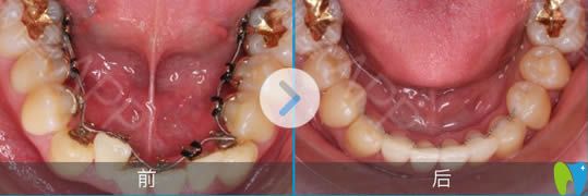 舌側(cè)矯正下頜牙前后對(duì)比照 舌側(cè)矯正下頜牙前后對(duì)比照