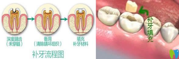 有關(guān)補(bǔ)牙會不會越補(bǔ)越爛和千萬不要去補(bǔ)牙的真相大揭秘
