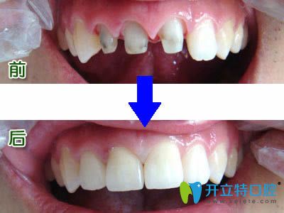 臺(tái)州維多利亞口腔于文學(xué)主任美容冠修復(fù)效果對(duì)比圖 臺(tái)州維多利亞口腔于文學(xué)主任美容冠修復(fù)效果對(duì)比圖