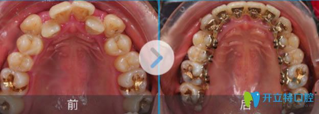 <!--<i data=20240703-sp></i>-->伊萊美舌側(cè)隱形矯正齙牙前后對比圖