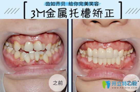 牙齒擁擠選擇3m金屬托槽矯正前后對比效果