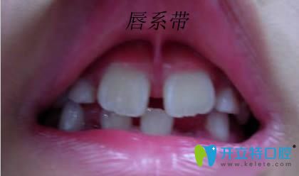 上唇系帶修整術(shù)是什么？唇系帶斷了修復(fù)時(shí)間是何時(shí)