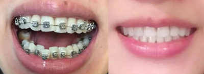 24歲正畸不算晚，聊聊我在西安畫美口腔做牙齒矯正那些事