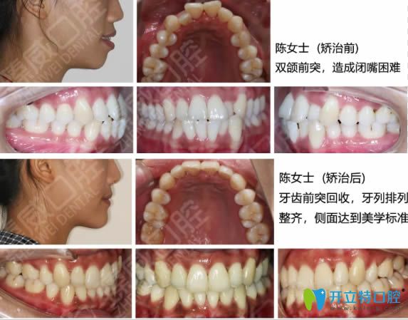 <!--<i data=20240703-sp></i>-->臻威口腔魏東院長(zhǎng)雙頜前突矯正前后對(duì)比效果