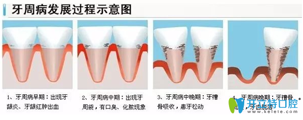 牙齦萎縮發(fā)展過程圖
