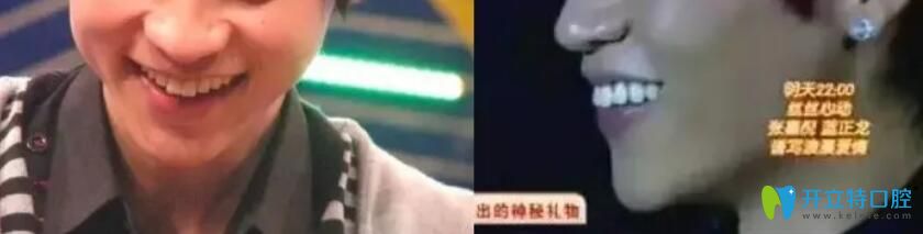 為什么明星都要做烤瓷牙呢