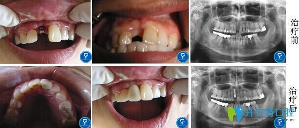 北京京通口腔單顆牙缺失即刻種植案例 北京京通口腔單顆牙缺失即刻種植案例