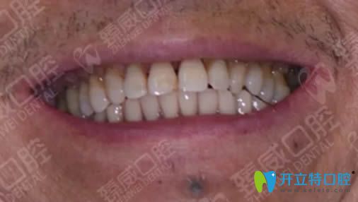 在<!--<i data=20240703-sp></i>-->臻威做完allon4即刻種植牙后的效果 在<!--<i data=20240703-sp></i>-->臻威做完allon4即刻種植牙后的效果