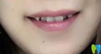 在臺州維多利亞口腔戴隱形牙套一年半了 來個前后對比效果