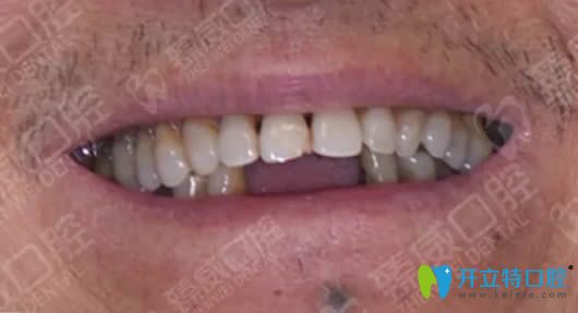 上海臻威口腔allon4種植牙真實(shí)案例 講述我種植牙1年后的感受