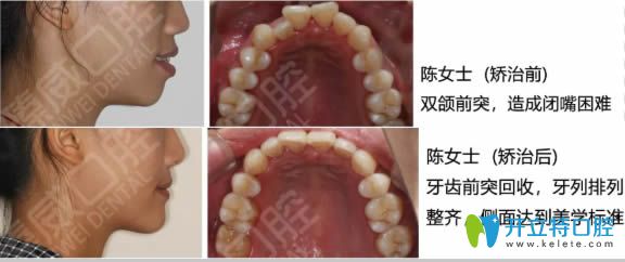 <!--<i data=20240703-sp></i>-->臻威口腔魏東醫(yī)生隱適美齙牙矯正前后對比照