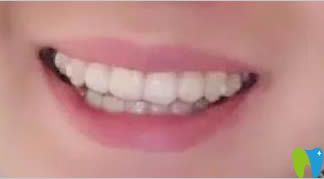 時(shí)代天使隱形矯正1年效果