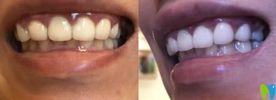 黃仁輝牙貼面美容效果對(duì)比圖 黃仁輝牙貼面美容效果對(duì)比圖