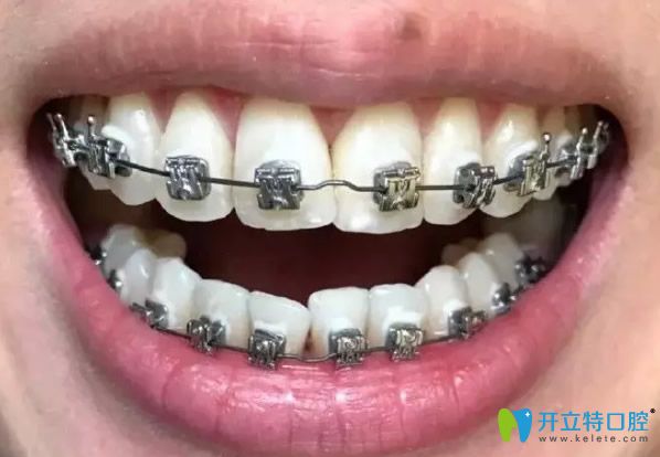 牙齒矯正第37天