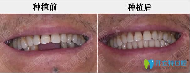 魏東下頜多顆牙缺失即刻種植牙前后對(duì)比照