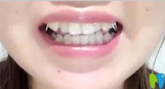 我在臺(tái)州維多利亞口腔做戴隱形牙套17副時(shí)效果圖