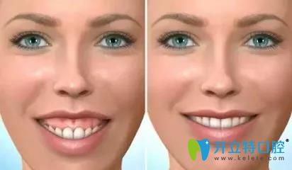 露齦笑的治療方案