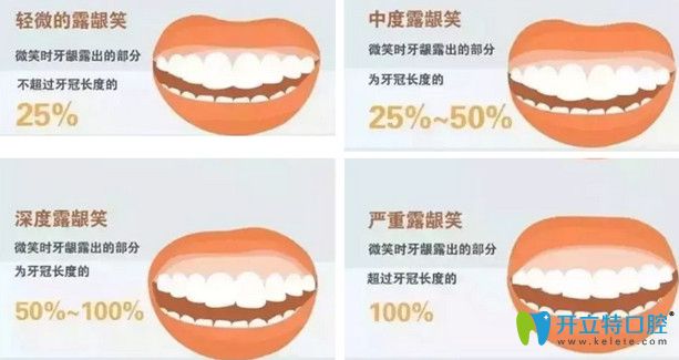 露齦笑可以矯正嗎？公布露齦笑手術(shù)費(fèi)用及矯正前后對比照