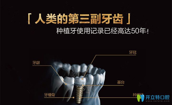 深圳好佰年種植牙技術 深圳好佰年種植牙技術