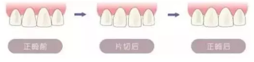 做的片切正畸后悔死了：深究牙齒片切矯正的危害有哪些？